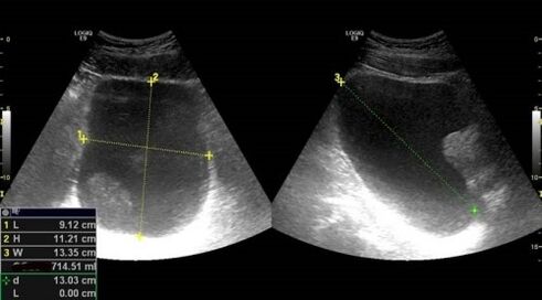 objawy zapalenia gruczołu krokowego w badaniu ultrasonograficznym