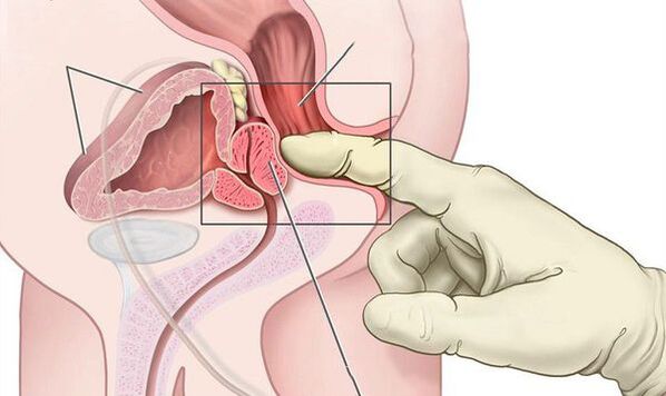 badanie per rectum prostaty